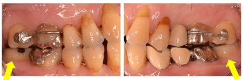 インプラント矯正