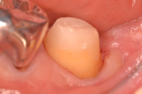 歯の移植