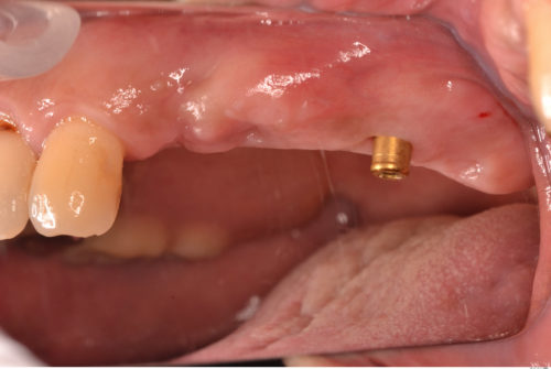 片側遊離端義歯　インプラント