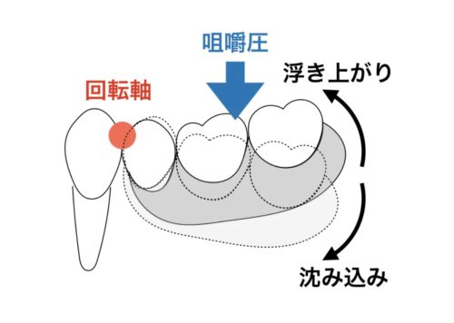 片側遊離端義歯　インプラント