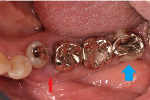 歯牙移植　歯周病