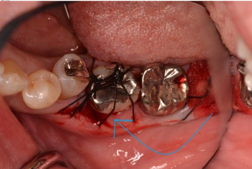 歯周病　歯牙移植