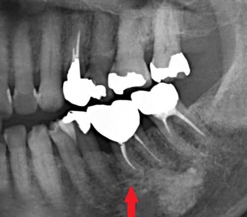 歯牙移植　歯周病