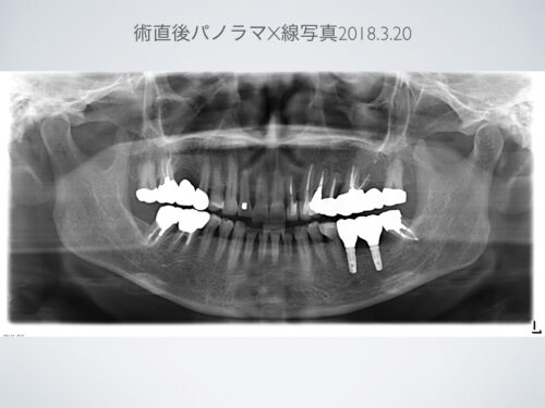 サージカルガイド