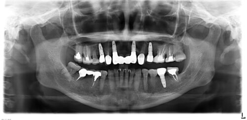 インプラント長期症例