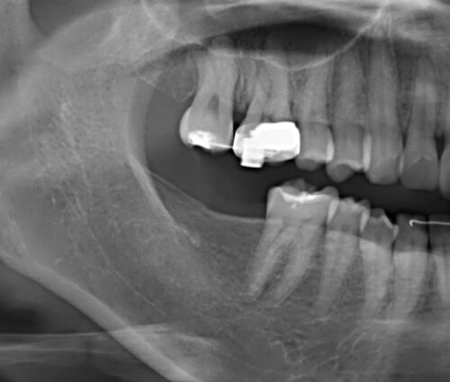 インプラントと矯正