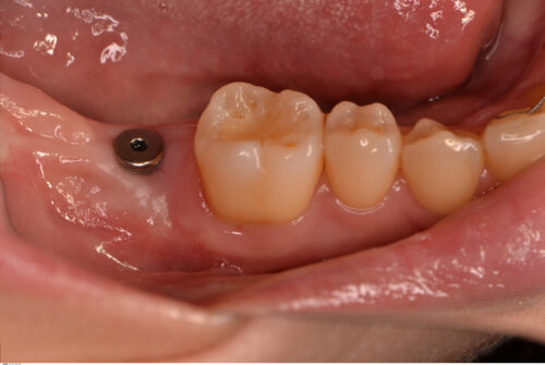 インプラントと矯正