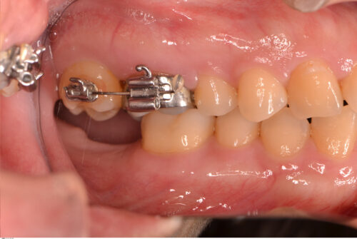 インプラントと矯正