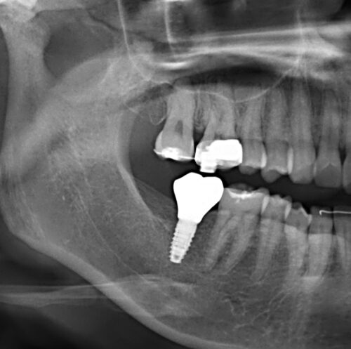 インプラントと矯正