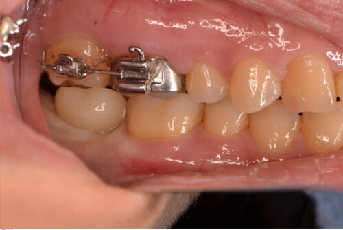 インプラントと矯正