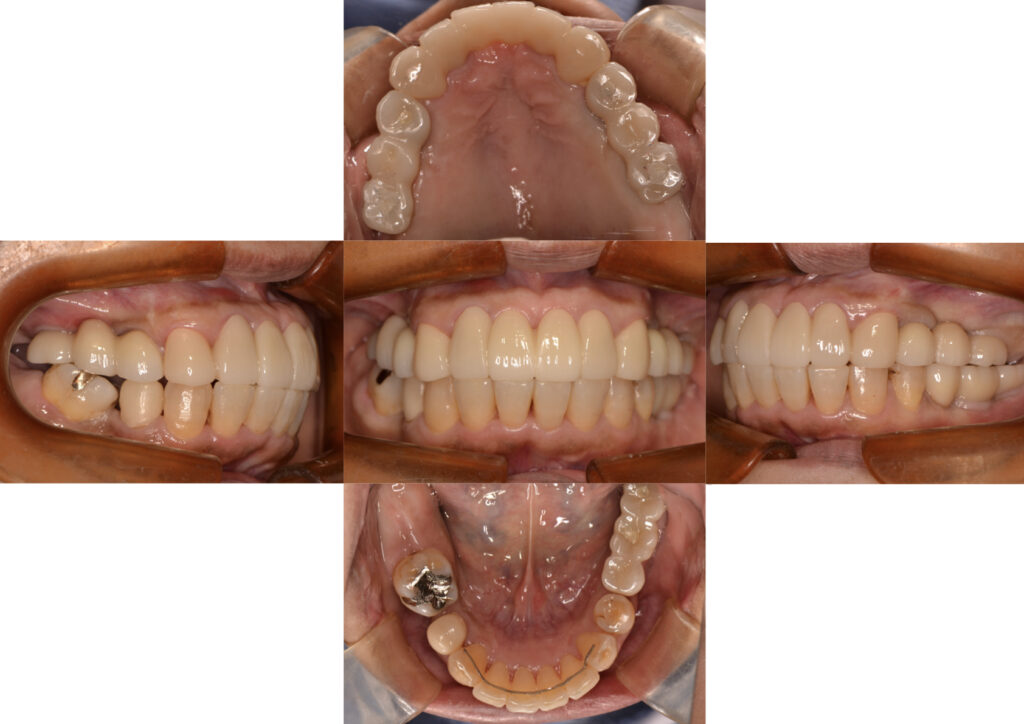 フルマウスリコンストラクション