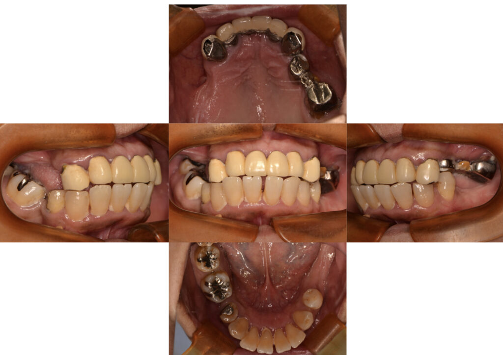 フルマウスリコンストラクション