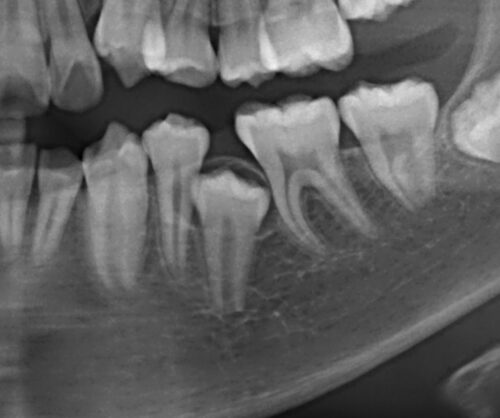 永久歯（大人の歯）が生えてこない