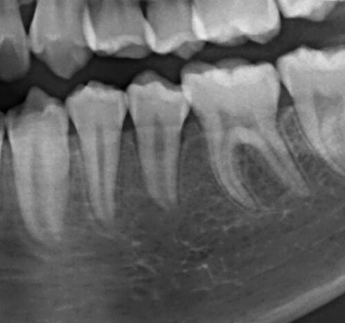 永久歯（大人の歯）が生えてこない