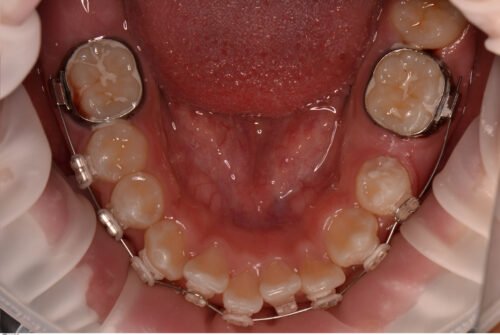 永久歯（大人の歯）が生えてこない