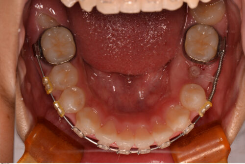 永久歯（大人の歯）が生えてこない