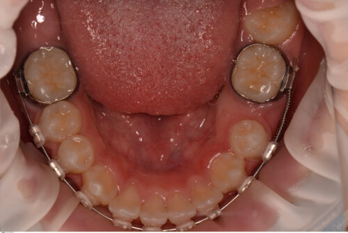 永久歯（大人の歯）が生えてこない