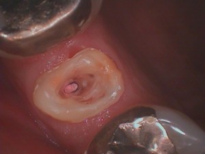 根管形成した歯の写真