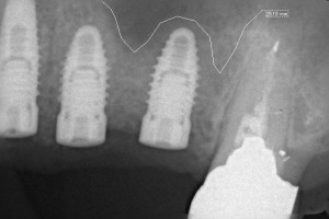 インプラント埋入後レントゲン