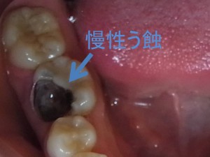 慢性齲蝕の写真