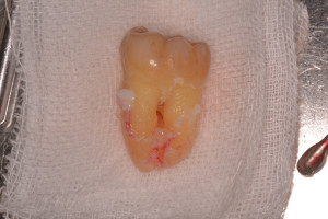 移植歯