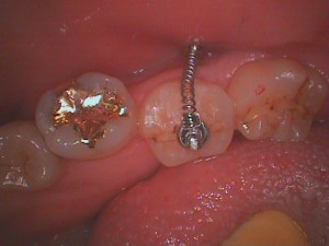 舌側傾斜歯の矯正治療